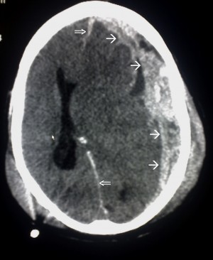This scan locates the bleeding of brain with the white arrows.